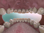 Dental Biofilm, Dysbiosis & Disease